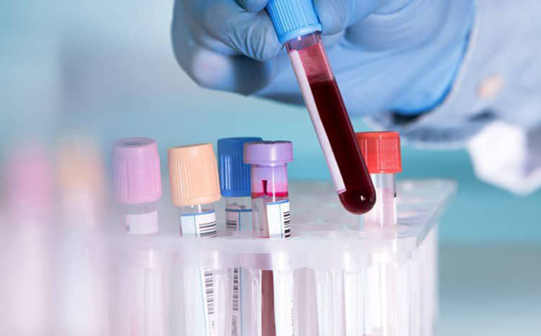 Xét nghiệm máu chẩn đoán viêm đa khớp dạng thấp