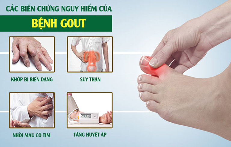 Biến chứng bệnh gout