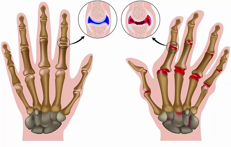 Viêm khớp dạng thấp tại các khớp ngón tay
