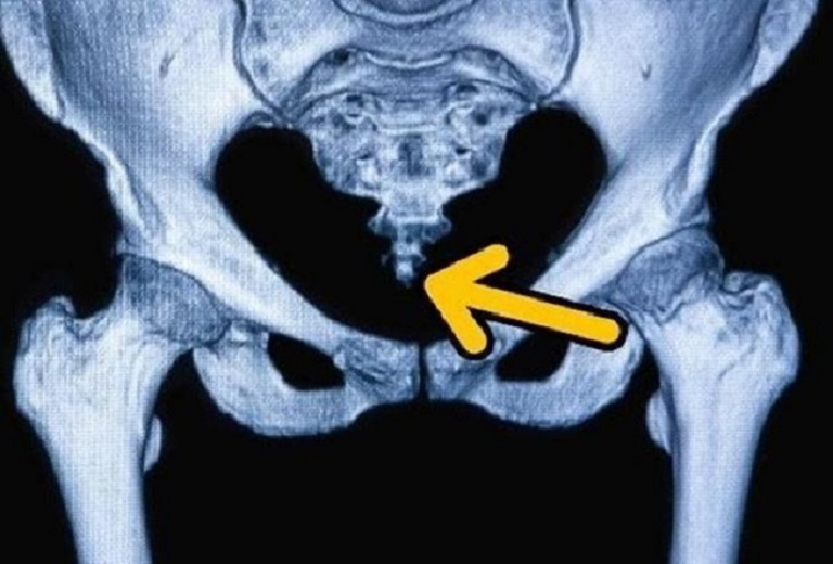 Hình ảnh chụp X-quang đốt sống cụt