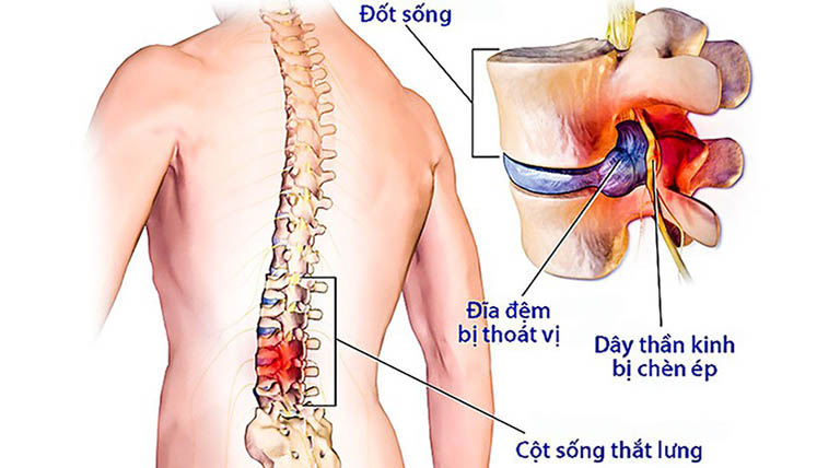 Bệnh thoái hóa cột sống lưng có thể biến chứng thành thoát vị đĩa đệm 