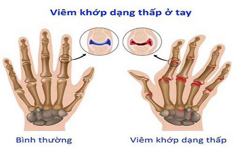Bệnh viêm khớp dạng thấp ở ngón tay