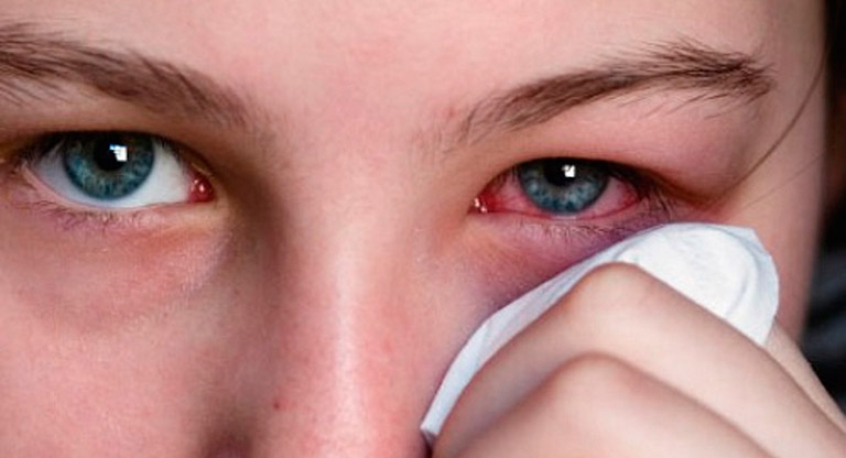 Tổn thương về mắt do bệnh lý khiến cho giác mạc bị khô