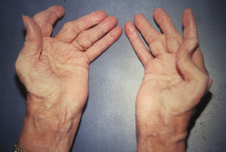 Đau khớp ngón tay do viêm khớp dạng thấp là bệnh lý thường gặp