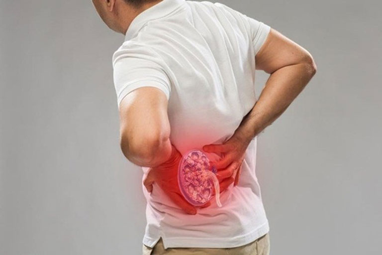 Đau lưng do nhiễm trùng thận có thể lan đến hông và bẹn