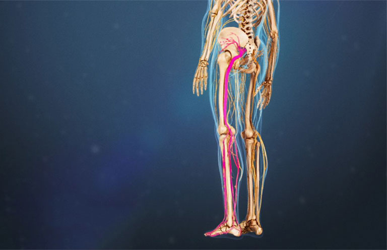 Đau thần kinh tọa dẫn đến các cơn đau từ hông, mông đến hai chân