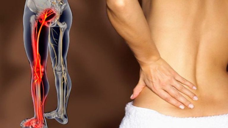 Các cơn đau thần kinh tọa có thể lan từ lưng, hông, mông xuống chân