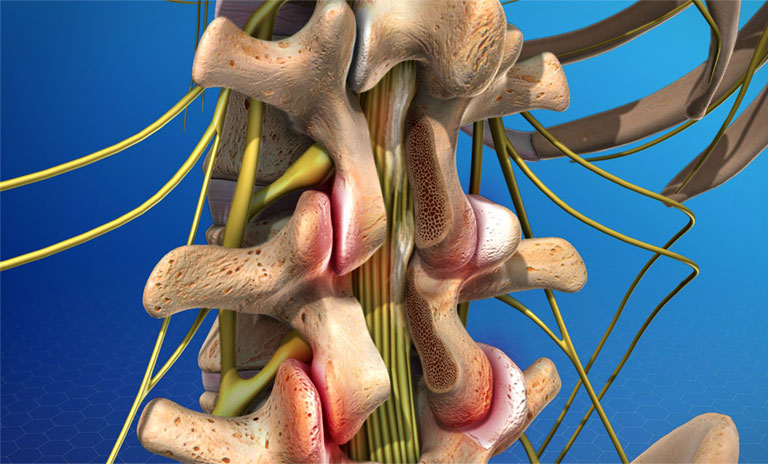 Mổ gai cột sống được chỉ định khi rễ thần kinh bị chèn ép