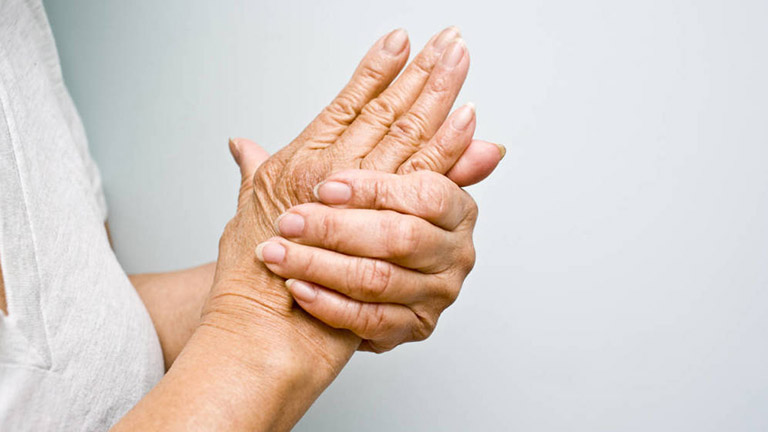 Sưng khớp ngón tay do viêm đa khớp dạng thấp có thể gây biến dạng khớp