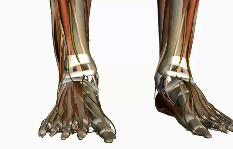 Thoái hóa khớp cổ chân thường xảy ra sau chấn thương, chẳng hạn như gãy xương cổ chân