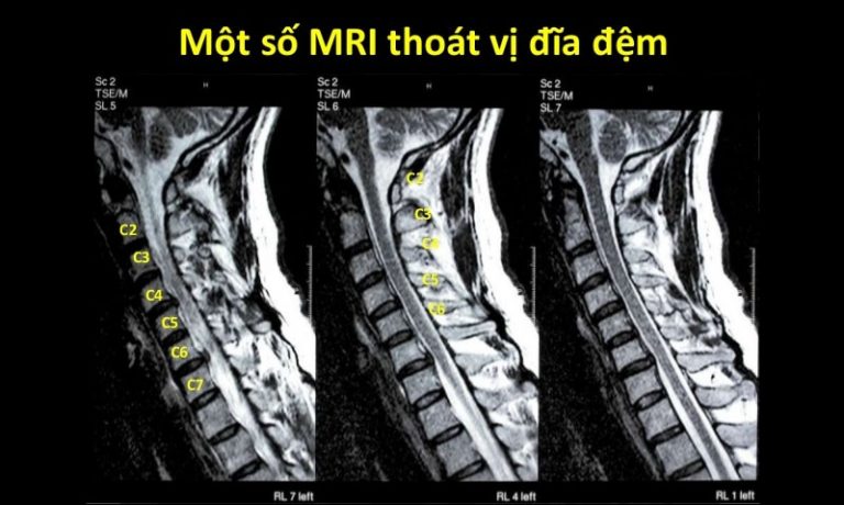 Thoát vị đĩa đệm chèn dây thần kinh là gì? Cách điều trị ra sao?