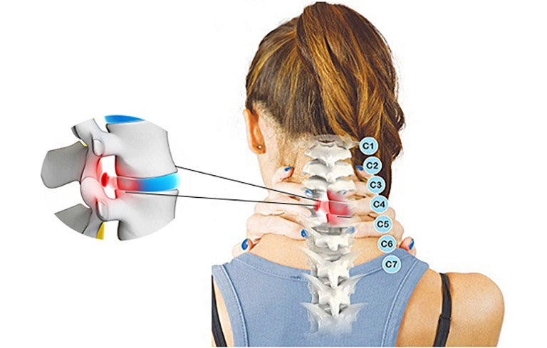 Thoát vị đĩa đệm cổ C5 C6 là căn bệnh thường gặp