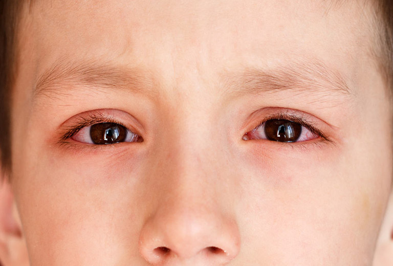 Biến chứng viêm khớp dạng thấp ở mắt