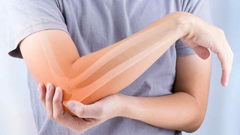Viêm khớp khuỷu tay thường xảy ra do viêm khớp dạng thấp (RA)