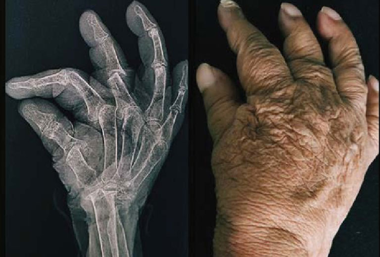 Viêm khớp ngoại biên biến dạng nặng thường gây ảnh hưởng bàn tay và bàn chân